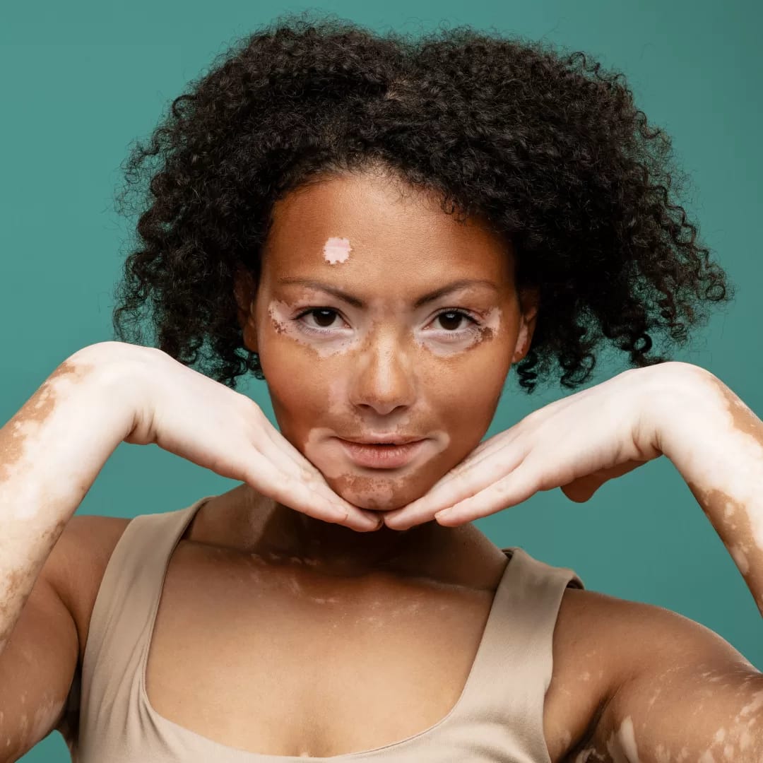 Vitiligo Spiritual Meaning A Deep Dive Into Its Symbolism The vitiligo-spiritual-meaning-a-deep-dive-into-its-symbolism-the